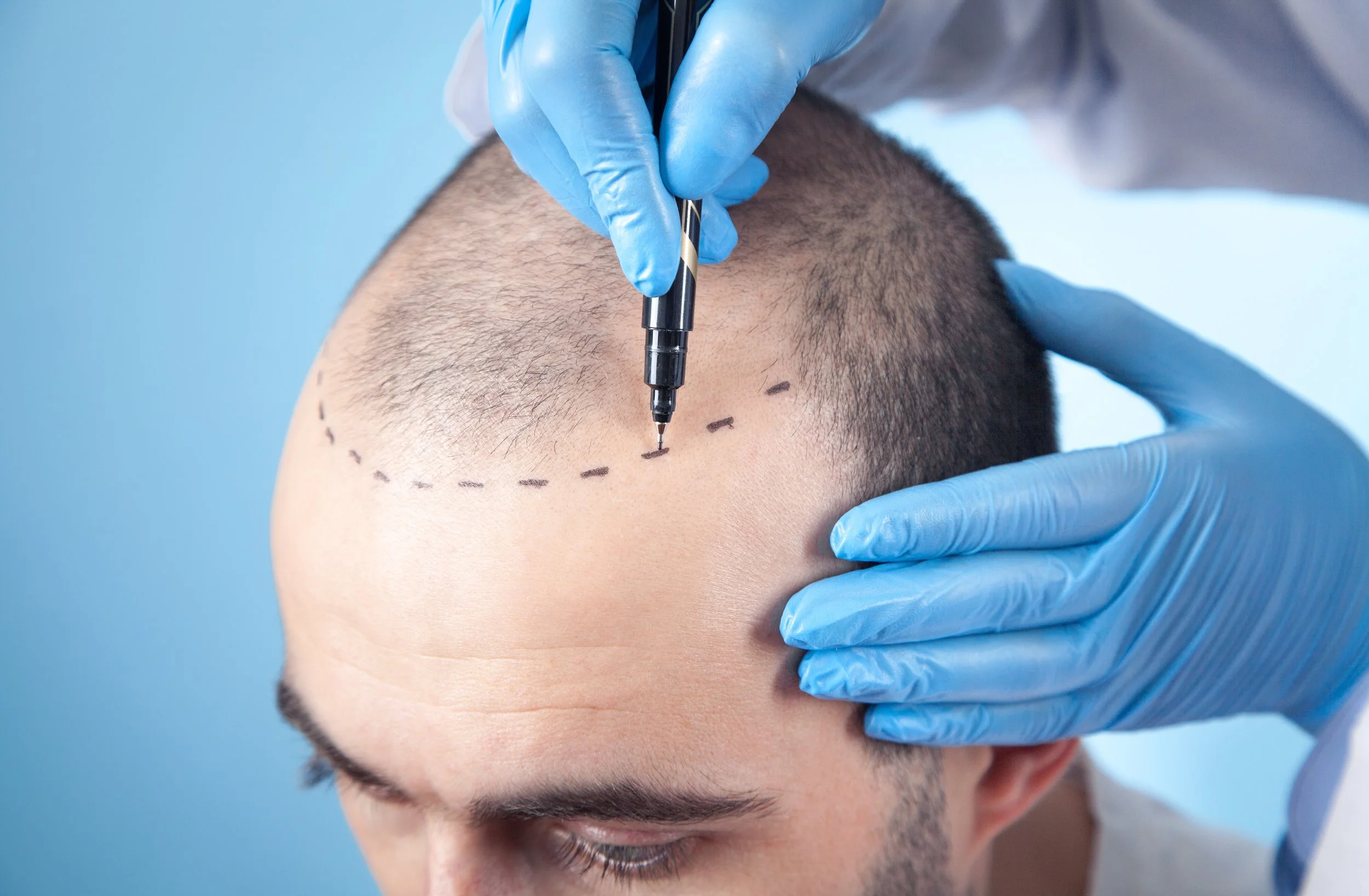 Best Hair Transplant London Clinic – Restore Your Hair with Experts