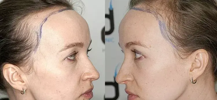 Hair Transplant Turkey Cost Guide for Medical Tourists
